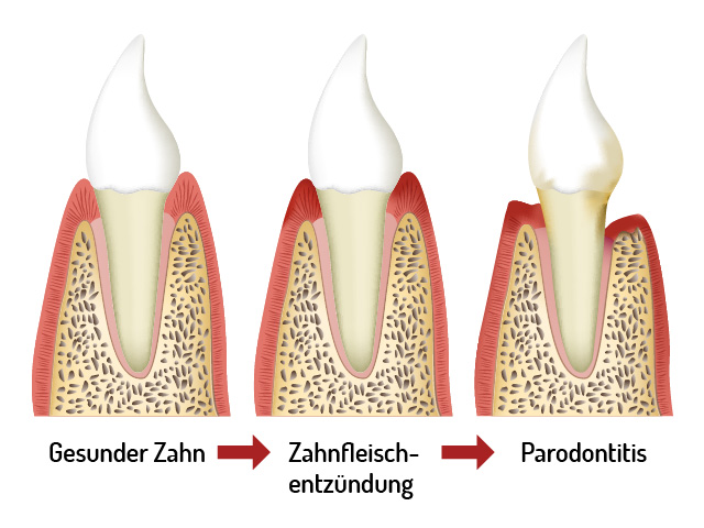 Entwicklung Parodontitis