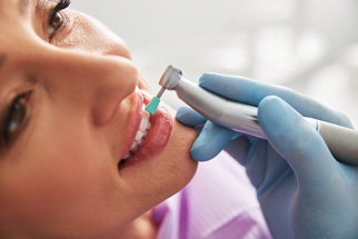 Polieren der Zähne bei der professionellen Zahnreinigung