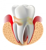 Zahn mit Parodontitis