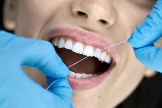 Einsatz von Zahnseide bei der professionellen Zahnreinigung
